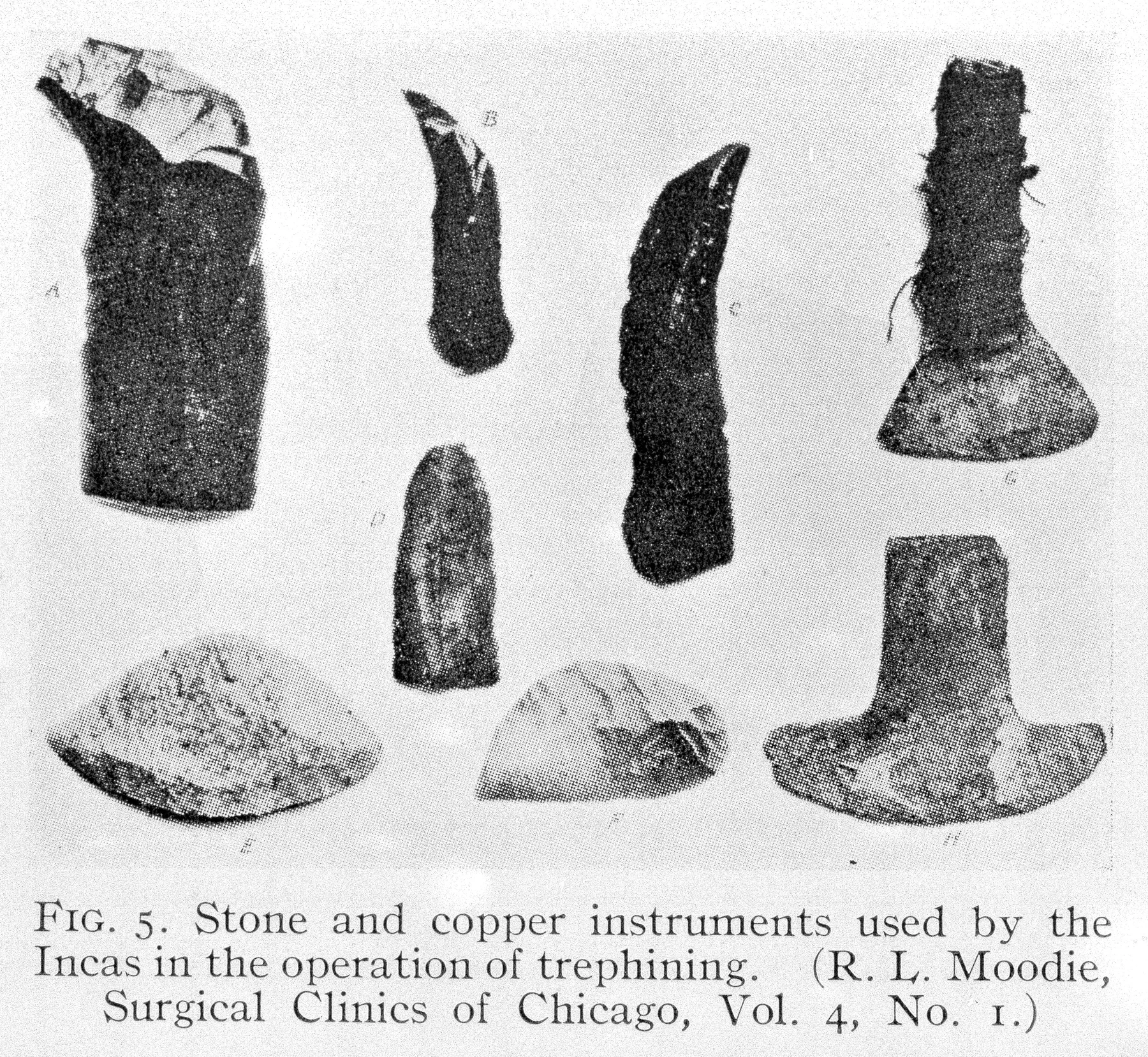 Archiwalna tablica przedstawiająca kamienne i miedziane narzędzia do trepanacji używane przez Inków.