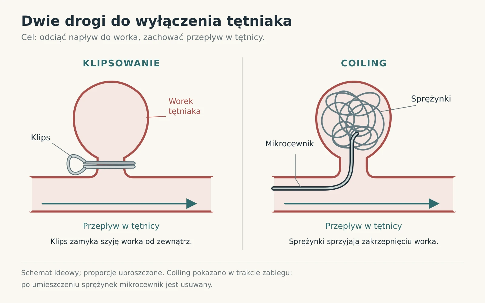 Schemat dwóch metod leczenia tętniaka: klipsowania i wprowadzania sprężynek.