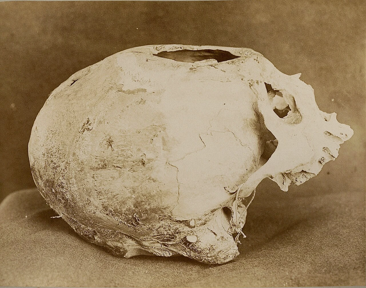 Boczny widok czaszki z Chaclacayo w Peru z widocznym otworem po trepanacji w sklepieniu.